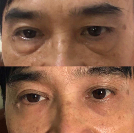 Haduhi - bí kíp tan bọng mỡ mắt, mờ nếp nhăn từ Hàn Quốc - 5