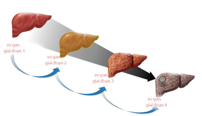 Hình ảnh các giai đoạn gan bị tổn thương