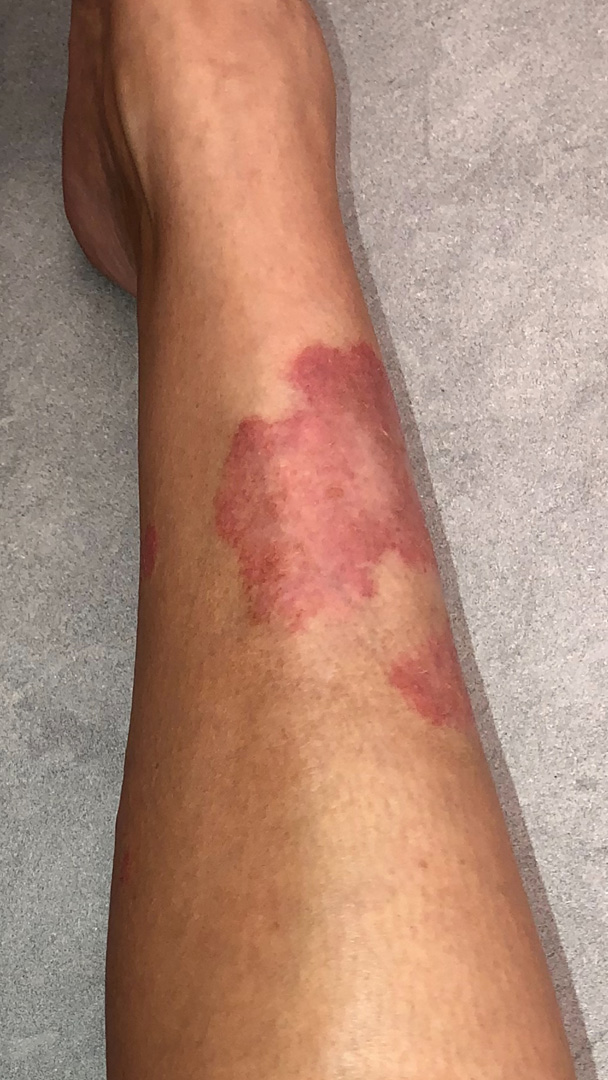 Vảy nến không chỉ ảnh hưởng đến sức khỏe mà còn làm bạn mất tự tin về ngoại hình.&nbsp;