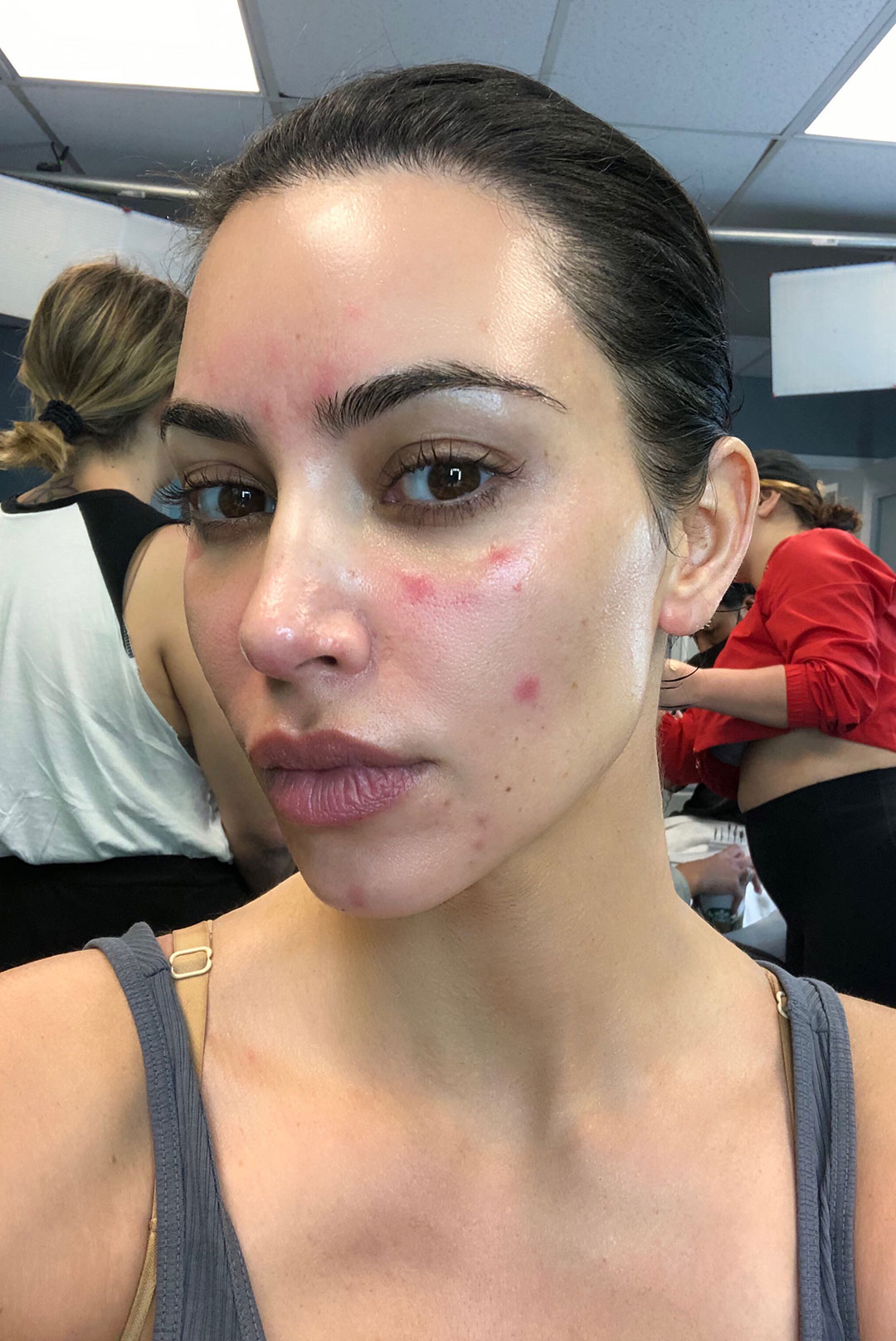 Kim Kardashian tự tin khoe mặt mộc đầy những vết đỏ do bệnh vảy nến.&nbsp;