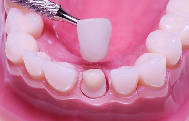 Thúy vi ngã gãy răng 13 triệu đồngchiếc tai nạn răng giả không hiếm hoi