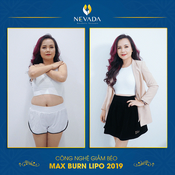 Diễn viên Hoàng Yến giảm béo bụng sau sinh bằng công nghệ Max Burn Lipo