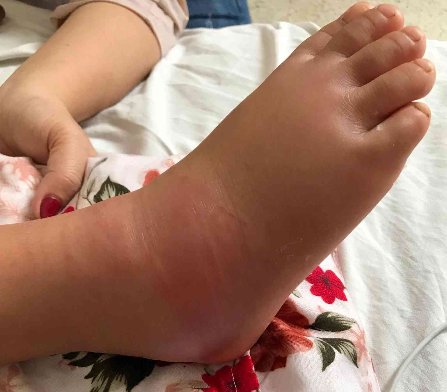 Chân của cháu Q. sưng phù. Ảnh chị Thảo cung cấp