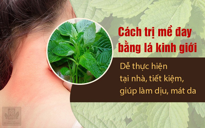 Cách trị nổi mề đay tại nhà có thực sự hiệu quả? Chuyên gia tư vấn - 2