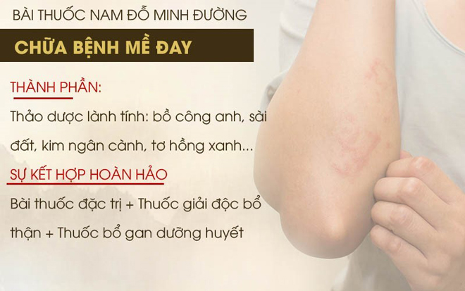 Cách trị nổi mề đay tại nhà có thực sự hiệu quả? Chuyên gia tư vấn - 5