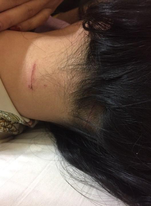 Vết thương trên cổ và đầu chị Trang.