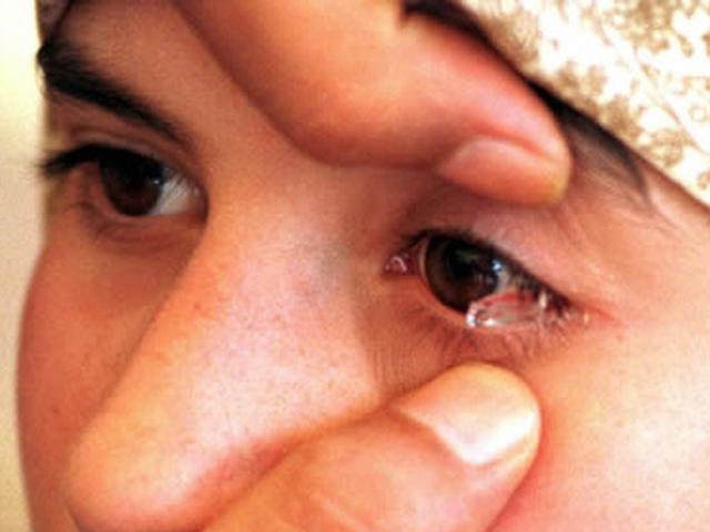 Kỳ lạ: Người phụ nữ khóc ra 50 viên ”pha lê” mỗi ngày
