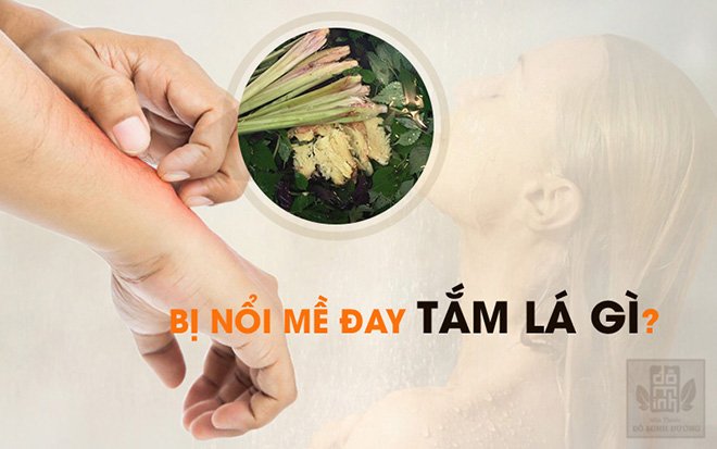 Bị nổi mề đay tắm lá gì? Đâu là cách chữa hết nổi mẩn, ngứa da hiệu quả - 1
