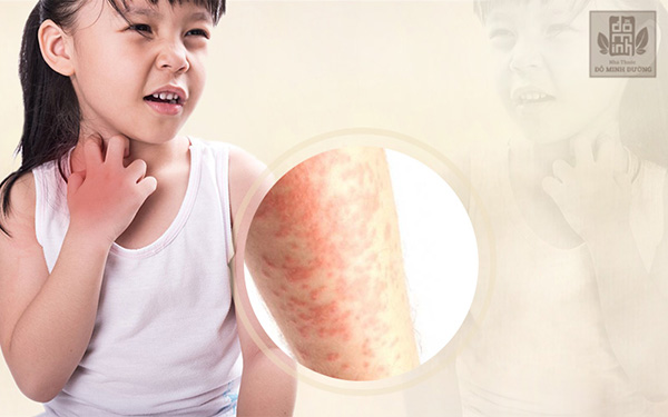 Nổi mề đay ở trẻ nhỏ và cách điều trị hết mẩn ngứa từ thảo dược tự nhiên - 1