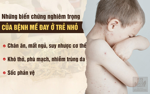 Nổi mề đay ở trẻ nhỏ và cách điều trị hết mẩn ngứa từ thảo dược tự nhiên - 2