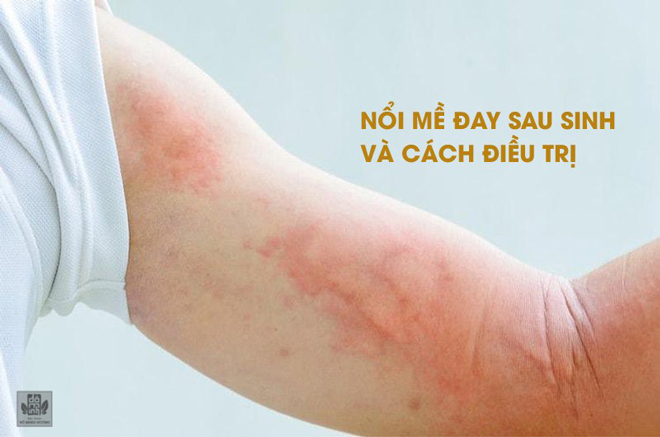 Nổi mề đay sau sinh bao lâu thì hết và cách điều trị không cần kháng sinh - 1