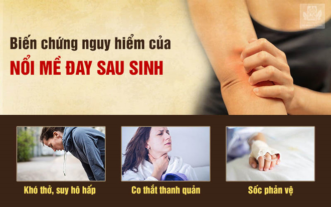 Nổi mề đay sau sinh bao lâu thì hết và cách điều trị không cần kháng sinh - 2