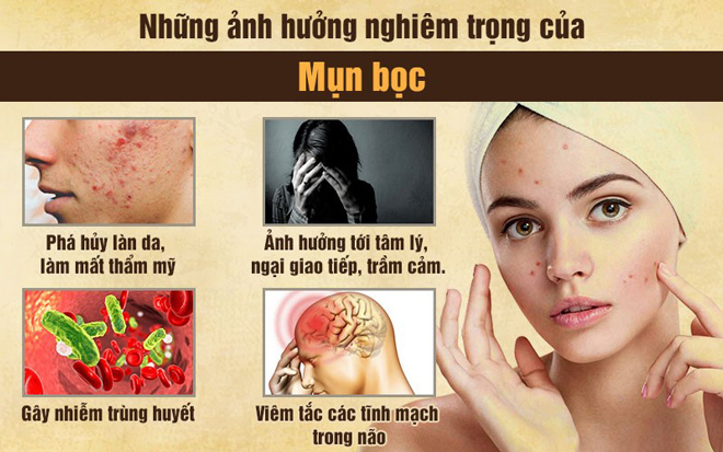 Mụn bọc và cách điều trị an toàn, hiệu quả, không để lại sẹo - 3
