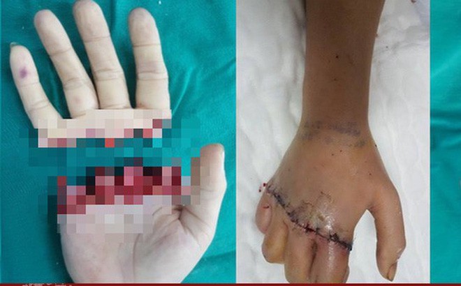 Các ngón tay bị đứt rời nối lại thành công. Ảnh minh họa.