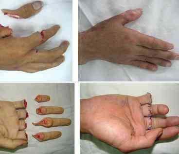 Chi đứt rời được nối lại. Ảnh minh họa.