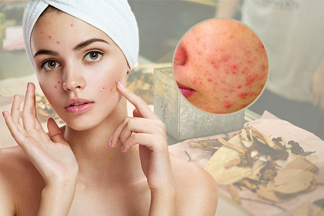 Mụn mủ và cách điều trị hiệu quả, đúng cách để không tái phát - 1