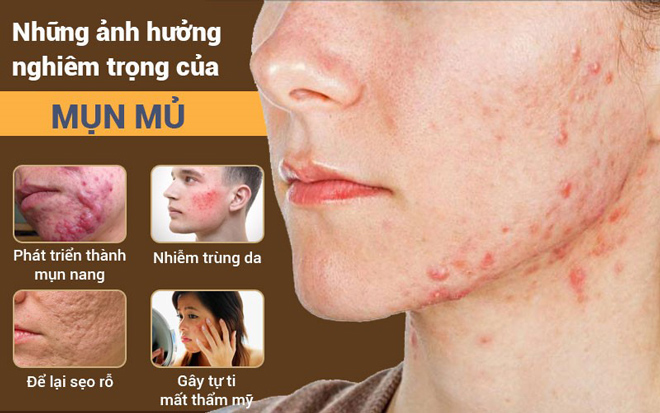 Mụn mủ và cách điều trị hiệu quả, đúng cách để không tái phát - 2
