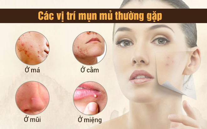 Mụn mủ và cách điều trị hiệu quả, đúng cách để không tái phát - 3