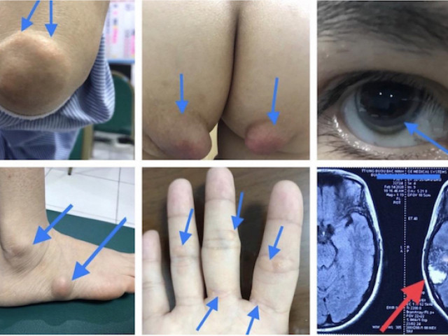 Sức khỏe đời sống - Căn bệnh di truyền ít được chú ý khiến cả gia đình 28 người mắc