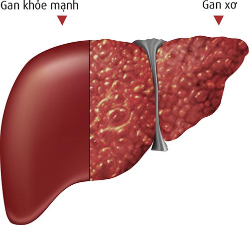 Đây mới là 6 món hủy hoại gan khiến gan của bạn 'hãi hùng' nhất, muốn gan khỏe mạnh cần tránh xa những thực phẩm này - 1