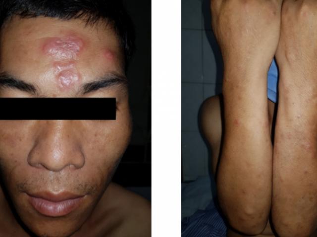 Sức khỏe đời sống - Bệnh phong: Căn bệnh tưởng chừng bị lãng quên lại "tái xuất"