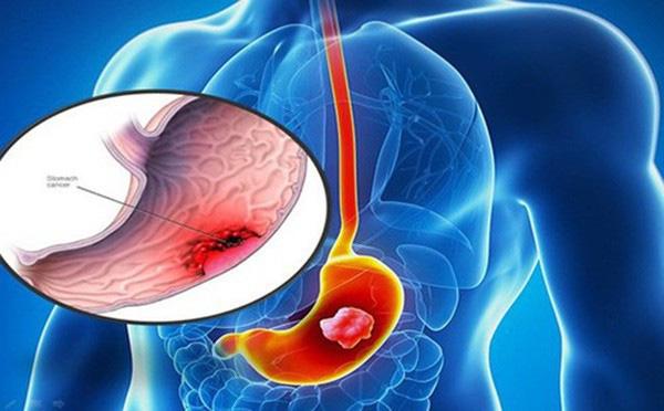 Bé 10 tuổi mắc ung thư dạ dày do chủ quan của người lớn, chuyên gia chỉ rõ 4 điều bố mẹ cần biết để tránh lây bệnh cho con - 2