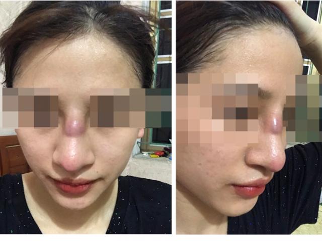 Sức khỏe đời sống - Mũi của cô gái trẻ lồi lõm, nhiễm trùng vì đặt sụn silicon tại spa