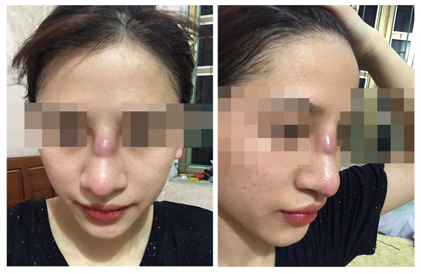 Bệnh nữ sinh năm 2001 tại Quảng Ninh bị áp xe (nhiễm trùng) mũi sau nâng mũi.