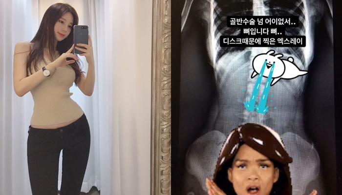 Cô đăng ảnh chụp x quang để chứng minh mình không hề phẫu thuật chỉnh hông.