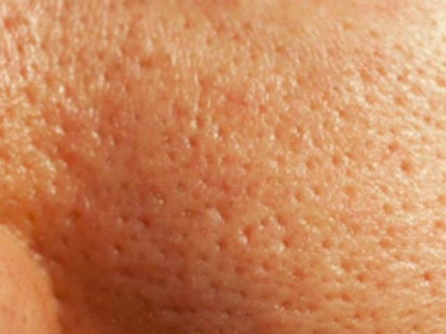 Sức khỏe đời sống - Vì sao lỗ chân lông trên da mặt càng ngày càng to?