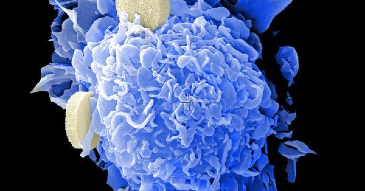 Sức khỏe đời sống - Phát hiện chất béo… tiêu diệt ung thư ngay trong cơ thể người