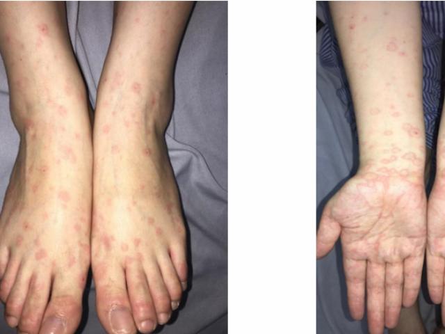 Sức khỏe đời sống - Sau xăm môi, người phụ nữ bị nhiễm vi khuẩn Herpes