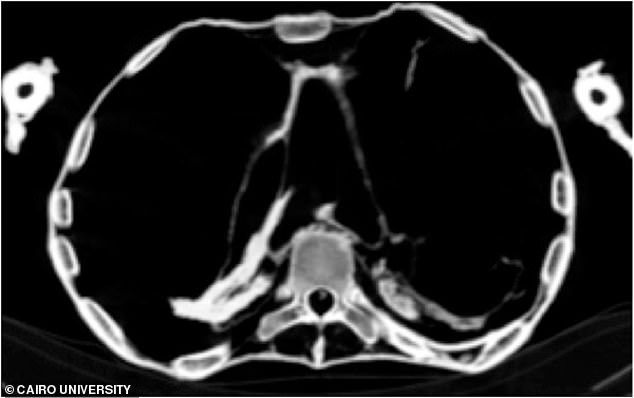 Các hình ảnh CT scan cho thấy "công chúa la hét" bị một cơn đau tim cấp do xơ vữa động mạch lâu ngày - ảnh: Đại học Cairo