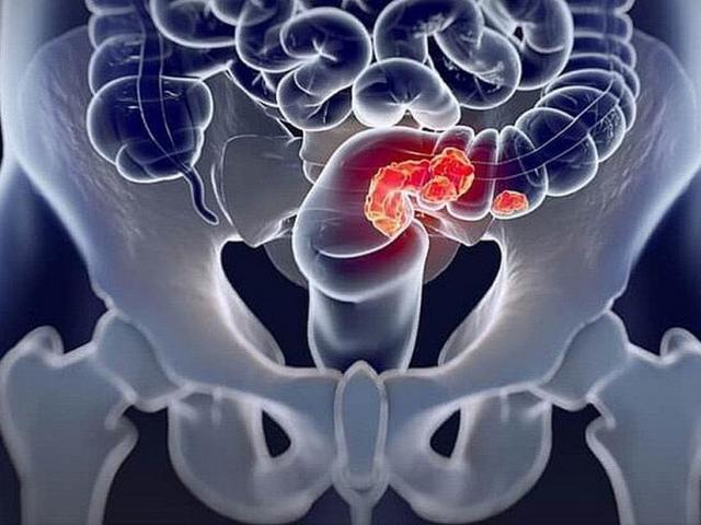 Sức khỏe đời sống - Những "thủ phạm" gây bệnh ung thư đại tràng, nếu biết hoàn toàn có thể phòng tránh được