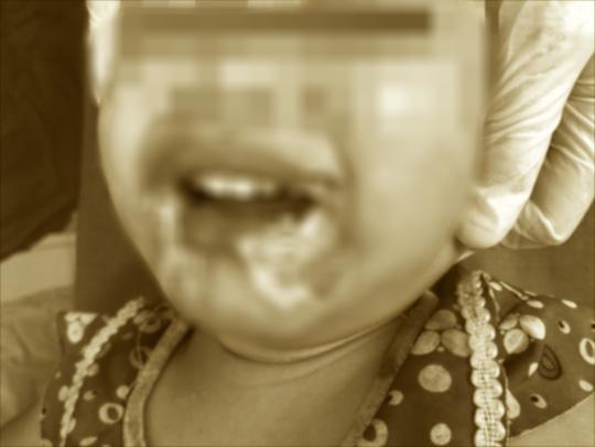 Cháu bé bị tổn thương bỏng vùng miệng do điện giật - Ảnh: Bệnh viện cung cấp