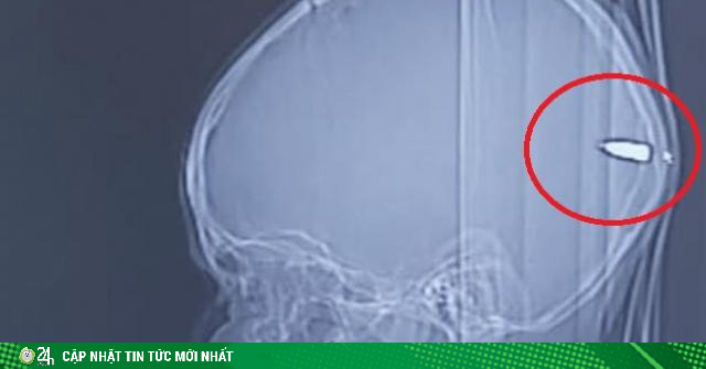 Thấy con hay buồn ngủ bố mẹ đưa đi chụp CT và phát hiện sốc