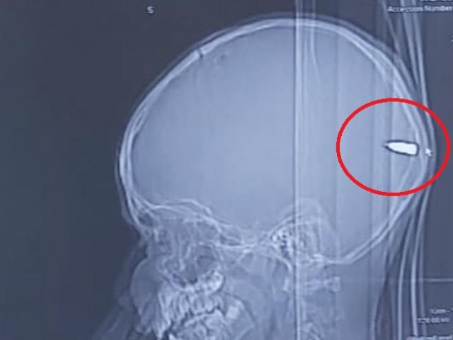 Phi thường - kỳ quặc - Thấy con hay buồn ngủ bố mẹ đưa đi chụp CT và phát hiện sốc