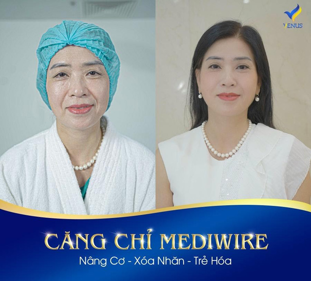 Quy trình căng chỉ Mediwire "đột phá" thị trường thẩm mỹ - 3