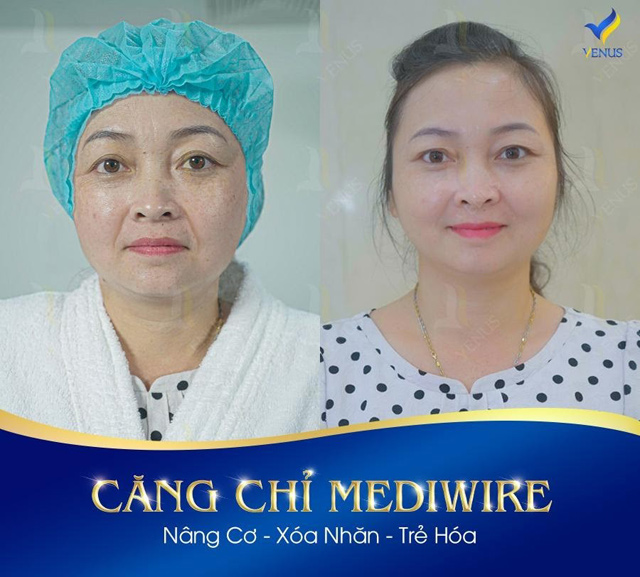 Quy trình căng chỉ Mediwire "đột phá" thị trường thẩm mỹ - 1