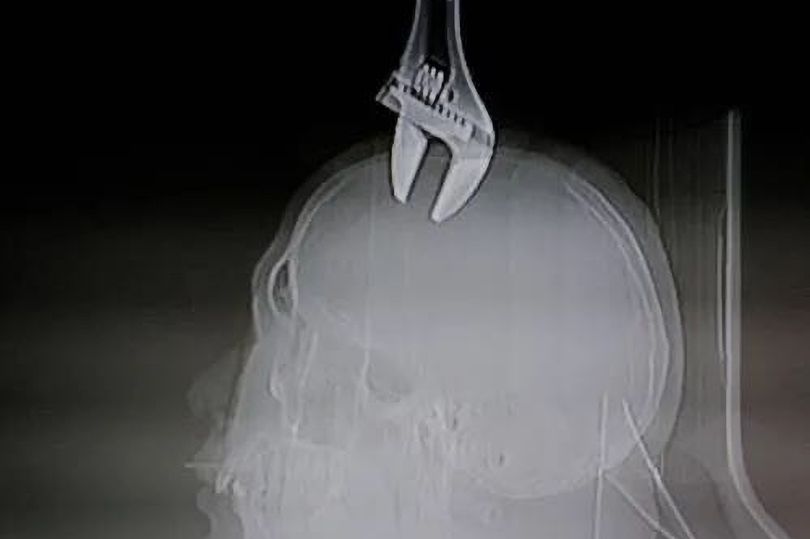 Ảnh chụp X-quang cho thấy chiếc cờ lê găm sâu vào đầu bệnh nhân.