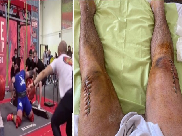 Thể thao - Lực sĩ nâng tạ 400kg bị gãy 2 đầu gối đăng ảnh "nếu yếu tim đừng có nhìn"