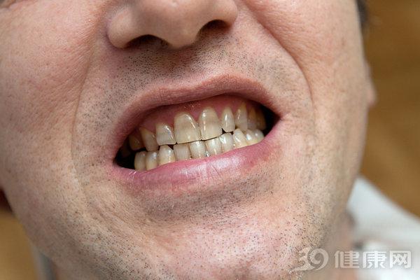 Đại học Harvard công bố kết quả nghiên cứu 20 năm về mối liên hệ giữa răng miệng và ung thư: Người có hàm răng xấu tăng nguy cơ mắc 2 bệnh ung thư - 1