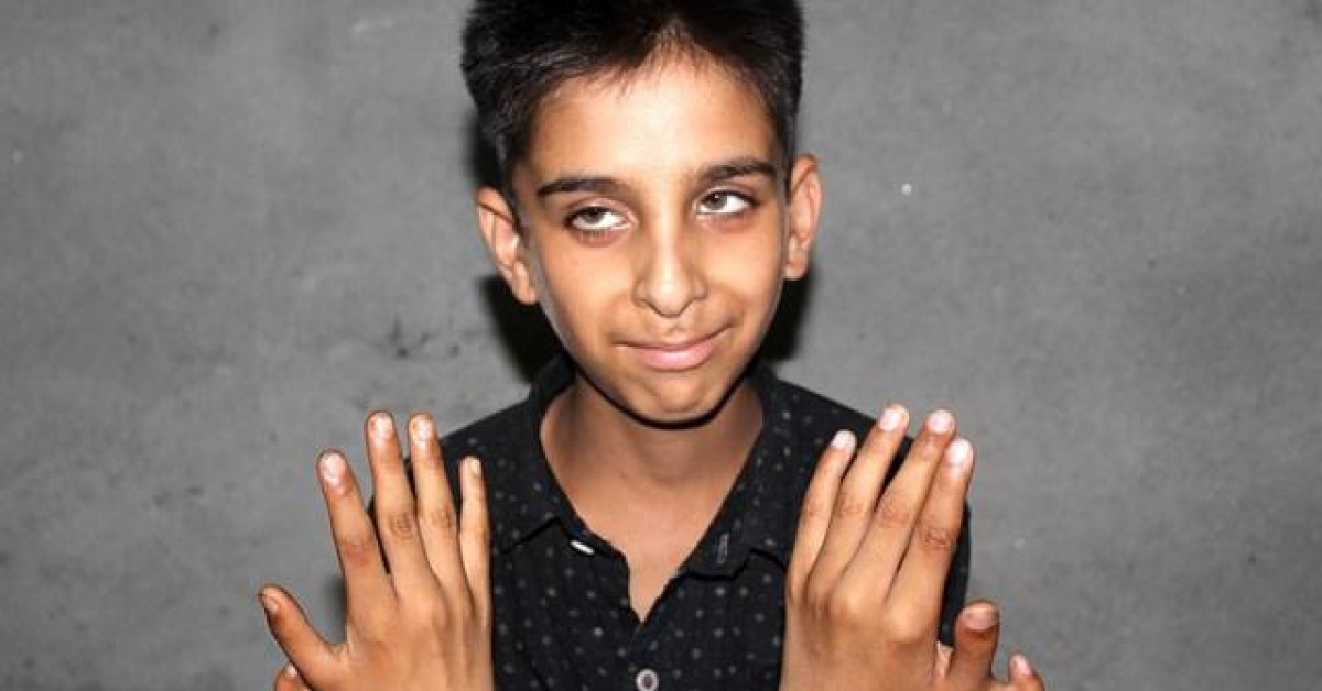 Bạn trẻ - Cuộc sống - Cậu bé có 12 ngón tay: Không xấu hổ, tự hào vì nhiều ngón tay mà chơi game giỏi