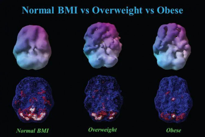 Cân nặng ảnh hưởng thế nào đến não? Kết quả đáng sợ khi quét não - 2