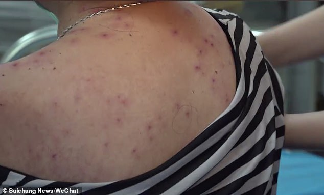 Vết ong đốt xuất hiện chi chít trên da người phụ nữ. Ảnh: Suichang News