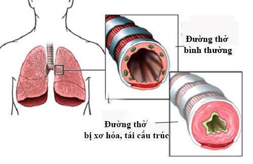 Làm sao để cải thiện các cơn ho khan kéo dài vào ban đêm an toàn, hiệu quả? - 2