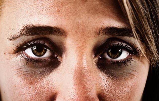 Xuất hiện quầng thâm ở mắt đừng chủ quan, rất có thể bạn đã mắc 1 trong 5 bệnh nguy hiểm này - 1