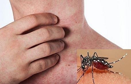 Chủ quan với bệnh sốt xuất huyết có thể dẫn tới những biến chứng nguy hiểm. Ảnh minh họa