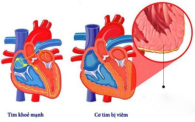 COVID-19 có thể ảnh hưởng đến tim, ngay cả sau khi đã hồi phục - 1