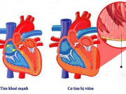 Sức khỏe đời sống - COVID-19 có thể ảnh hưởng đến tim, ngay cả sau khi đã hồi phục